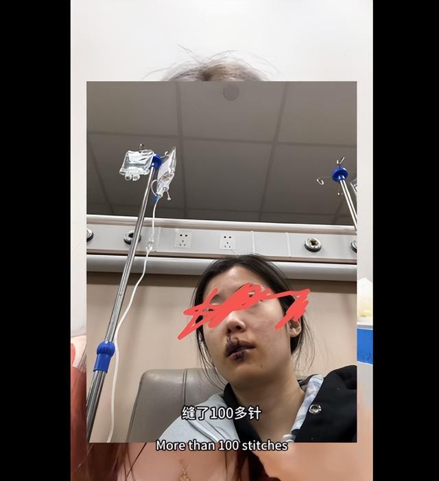 LPL美女主持遭遇意外事故，养伤数月终于复出，进医院缝100多针！