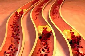 5个中成药活血化瘀、通络止痛，防治心梗脑梗，清除“血液污垢”图片