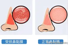 你的鼻炎是鼻粘膜不好了，2个中医方法内外兼治，提升鼻粘膜功能图片
