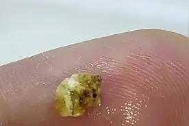 体外冲击波碎石能随便做吗？有什么并发症？要注意！图片