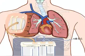 科普胸部手术后的引流管护理，教您如何轻松告别“管”束？图片