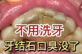 牙结石口臭不洗牙也能解决！过来人分享独家妙招！瞬间去臭不尴尬图片