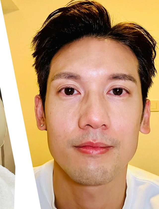 关智斌自曝煤气意外漏气致面部二级烧伤，公开康复期照片惹人心疼