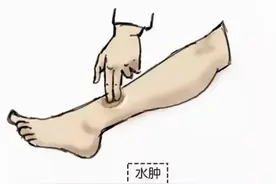 老年人下肢水肿需警惕！图片