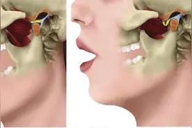 突然张不开嘴？吃东西耳边有声响？颞下颌关节紊乱病了解一下图片