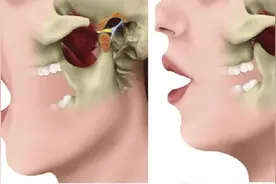 突然张不开嘴？吃东西耳边有声响？颞下颌关节紊乱病了解一下图片