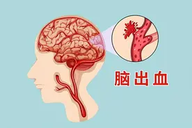 这5种症状，是脑出血的“前兆”，占的越多，越要警惕图片