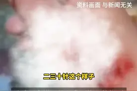 闹大了！16 岁少女洗澡时浴屏爆裂，送医后缝 20 多针，网友怒了！图片