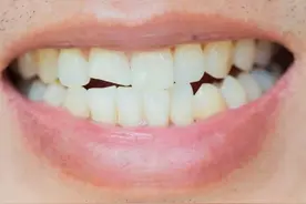 牙齿断了，牙根没掉，还有救吗？不管行不行？图片