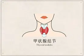 服碘131后出院第一天：服碘注意事项和需准备物资图片