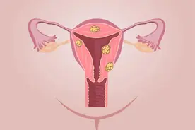 女性为什么容易长子宫肌瘤？医生提醒：建议远离4种行为，别大意图片