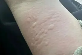 中医论荨麻疹五个类型图片