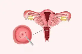 宫颈锥切术后康复指南：四点注意事项助你快速恢复图片