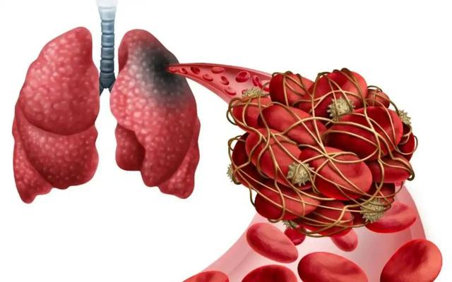 女子大腿酸痛，上午就诊，傍晚离世！医生：大腿疼痛背后问题不少