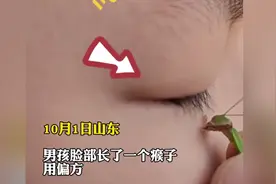 男孩脸上长了一个肉瘊子，听偏方，抓了只螳螂把肉瘊子吃干净了图片