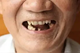 牙齿松动、咀嚼困难？不是老掉牙，而是骨骼对你发出的健康警告！图片