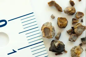 体检查出肾结石怎么办？医生：3个方法，帮助肾结石排出体外图片