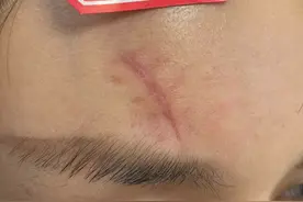 脸部疤痕有哪些？什么方法能快速去除？图片