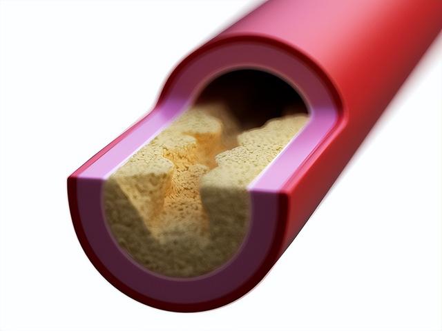 55岁女子突发脑梗去世，生前爱运动不熬夜	，丈夫哭诉：她不听我的