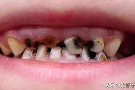 牙齿只剩下残根，是否需要拔除？图片