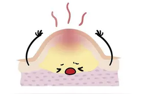 头皮上总能摸到疙瘩和脓包？或暗示3种疾病，别不当回事！图片