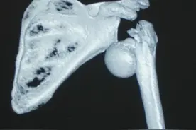 老人外出旅游"摔废"左肩，医生反肩关节置换术为她“重生”肩关节图片