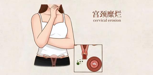 为何月经前后，会出现“褐色分泌物”？若你也有，建议对照看看