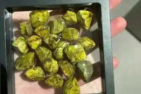 笑麻了！女子手术取的20多颗胆结石拿在手里把玩，网友：穿个手串图片