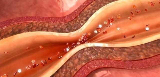 脑梗去世的人越来越多？医生劝告：天冷宁可喝凉水，也别做这3事