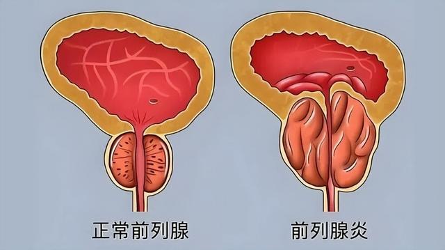 浙大研究：前列腺增生大量喝茶，用不了多久，身体或有6大变化