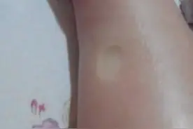 每到晚上，下肢就水肿☞出现的原因，中药调理及预防办法图片