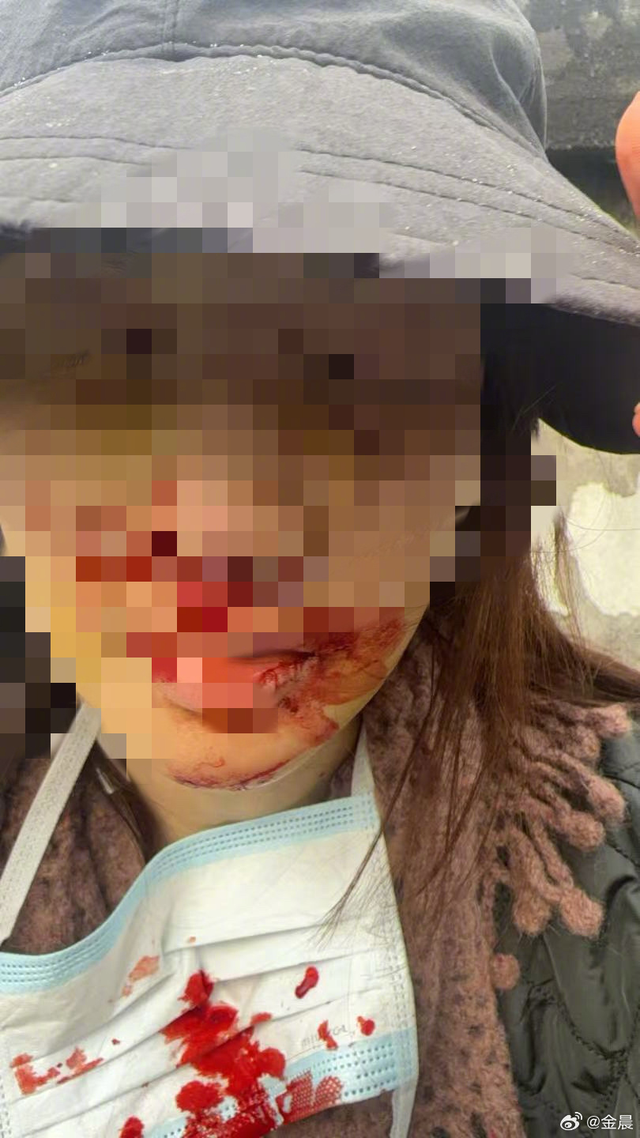 女演员金晨被曝“肇事逃逸让助理顶包”	，警方刚刚通报！本人发文回应交通事故详情，公布受伤照片