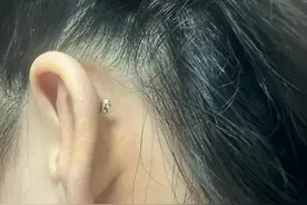 耳钉“钻”进肉里，女生追时髦打耳骨钉致感染图片