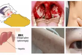 易误诊！6岁男孩脖子里长“肉包” 一地已收治10余例患儿！图片