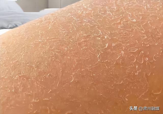 一脱衣服身上很多皮屑脱落，怎么回事？是缺维生素了？涨知识了！