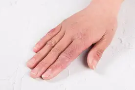 癣和皮炎可大不相同，尤其是这3个方面，别再乱用药啦图片