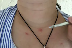 身上不起眼的小红痣，居然查出肝硬化？别大意，尤其是爱喝酒的人图片