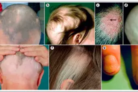 福建13岁少女头发眉毛全秃了！家长慌张求医，原因令人感慨……图片