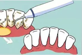 牙齿洗牙后，会更容易脏吗？看完后感觉真的要去洗牙了！图片