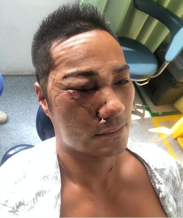 香港知名男星被砍留后遗症，脸皮险被砍掉，身上多处刀疤清晰可见