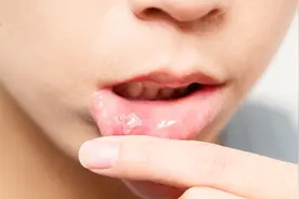 63岁大妈反复口腔溃疡，各种用药治不好，医生一句话直接让她崩溃图片