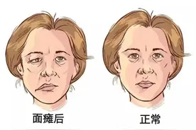 面瘫的那些事图片