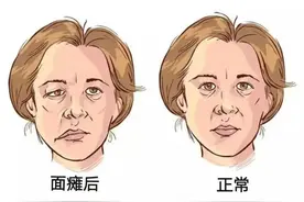 面瘫的那些事图片