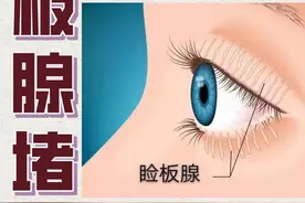 长治爱尔眼科医院：睑板腺堵塞是怎么回事？图片