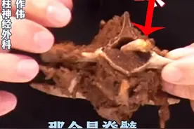 脊髓和神经到底什么关系？为什么有的颈椎病压神经，有的压脊髓？图片
