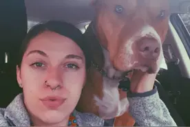 美国女孩遭家犬咬掉鼻子，移植头皮做手术后，鼻尖长出了“头发”图片