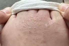 女子试完鞋后瘙痒难耐，密密麻麻全是……图片