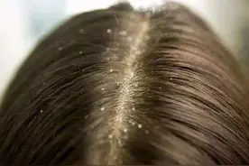 10岁男孩有头皮屑怎么办?图片