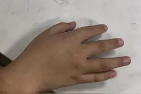 9岁自闭症男孩吐血、手肿，疑遭辅导机构老师殴打致骨折，警方立案调查图片