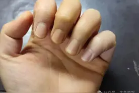 突然火了！碘伏成“美白神器”，医生：别信！图片